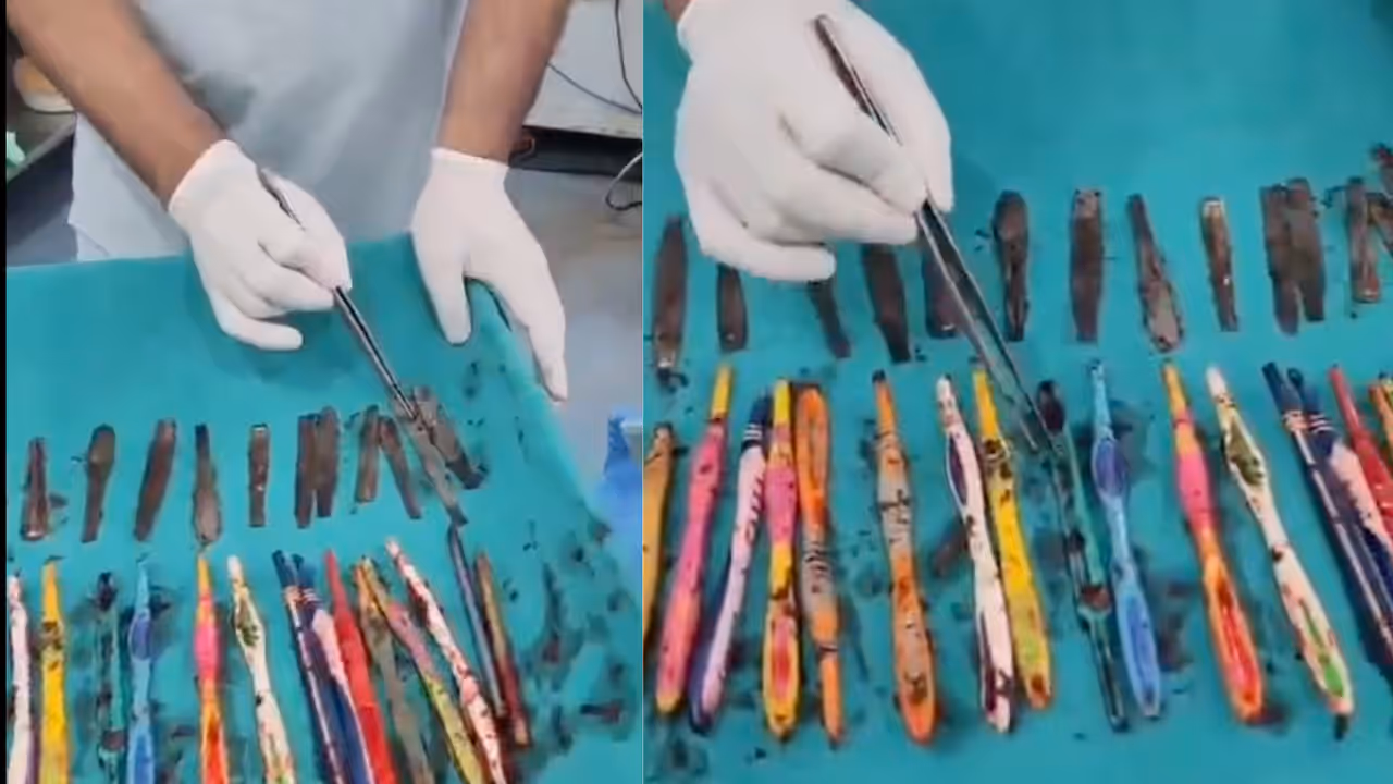 hapur man surgery 49 objects removed from stomach