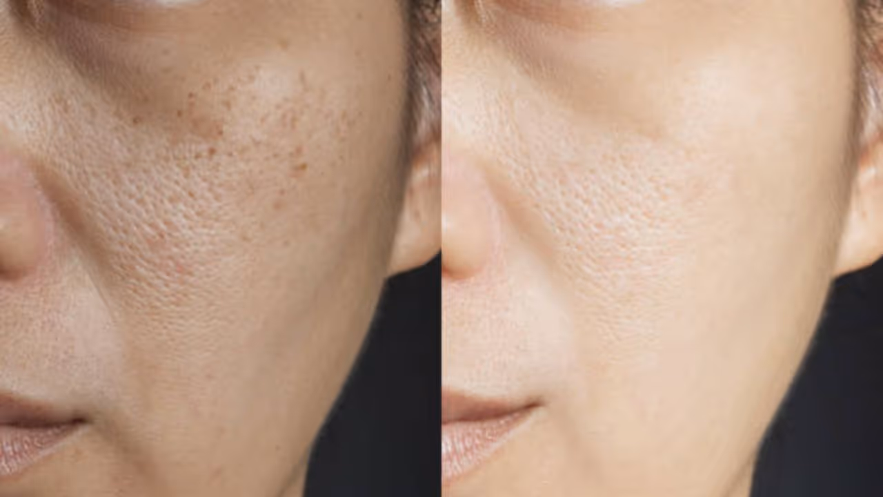 minimise pores by madhuri agrawal