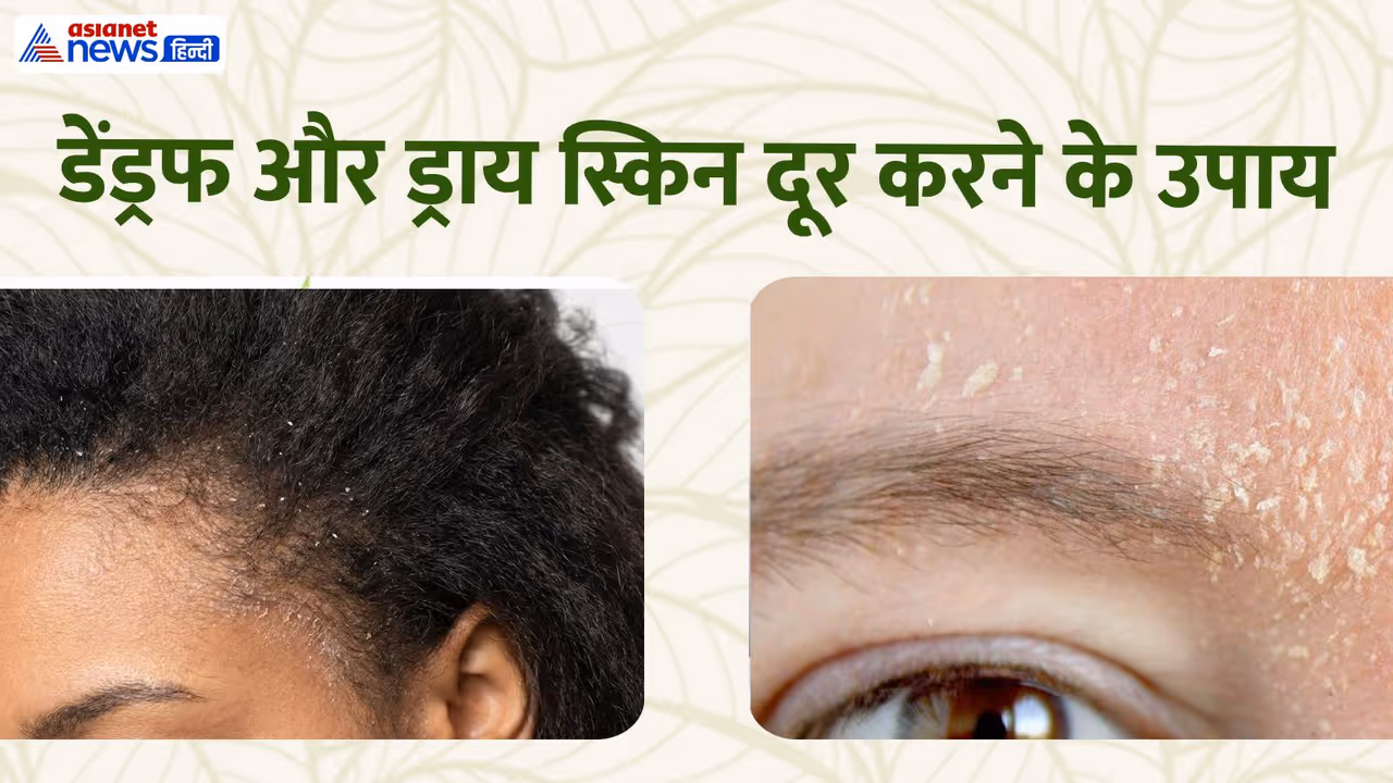ड्राय स्किन और डेंड्रफ ड्राय स्किन और डेंड्रफ