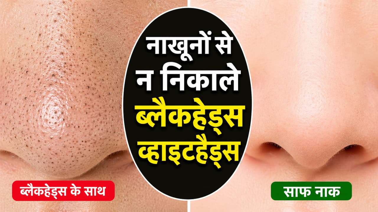 ब्लैकहेड्स ब्लैकहेड्स