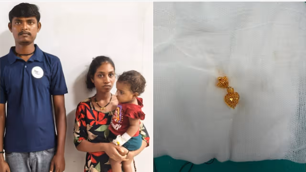 Surat Infant Swallows Gold Earring, Doctors Remove It in 45 Minutes Surat Infant Swallows Gold Earring, Doctors Remove It in 45 Minutes