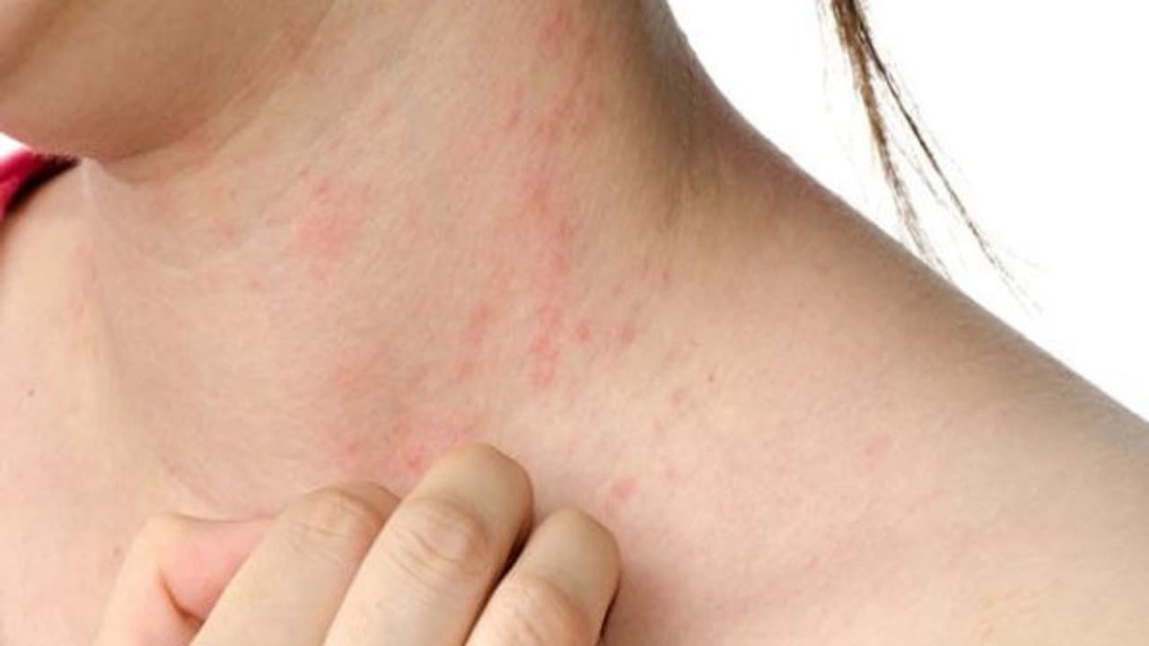 கோடை காலத்தில் ஏற்படும் அரிப்பு பிரச்சனையை தீர்க்க இதோ வழிகள்... கோடை காலத்தில் ஏற்படும் அரிப்பு பிரச்சனையை தீர்க்க இதோ வழிகள்...