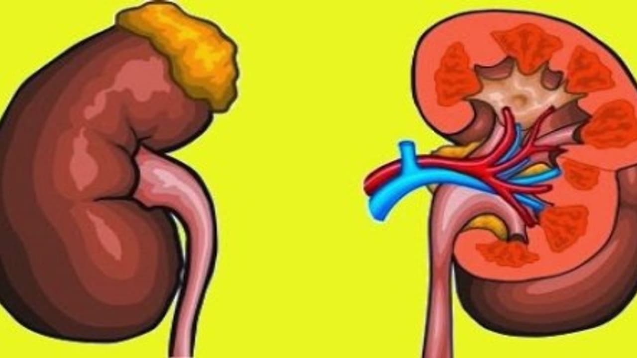 சிறுநீரகத்தை பாதிக்கும் 'நெப்ராடிக் சிண்ட்ரோம்' சிறுநீரகத்தை பாதிக்கும் 'நெப்ராடிக் சிண்ட்ரோம்'