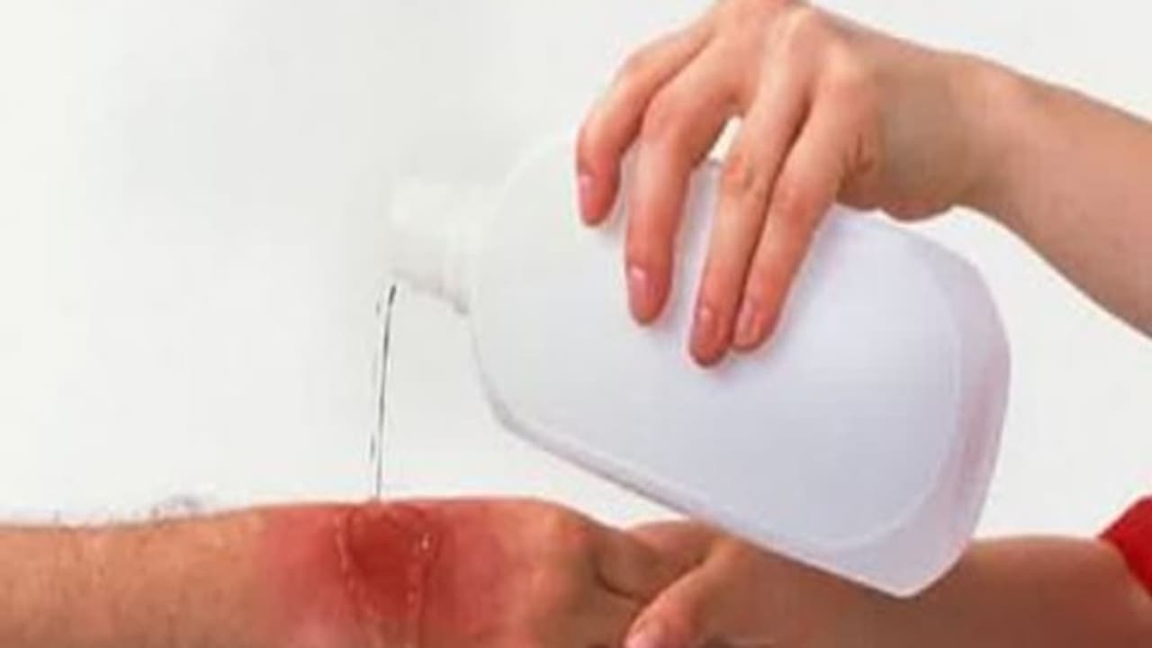 தீக்காயத்தால் பாதிக்கப்பட்டவருக்கு கொடுக்க வேண்டிய முதலுதவிகள் என்னென்ன? தீக்காயத்தால் பாதிக்கப்பட்டவருக்கு கொடுக்க வேண்டிய முதலுதவிகள் என்னென்ன?