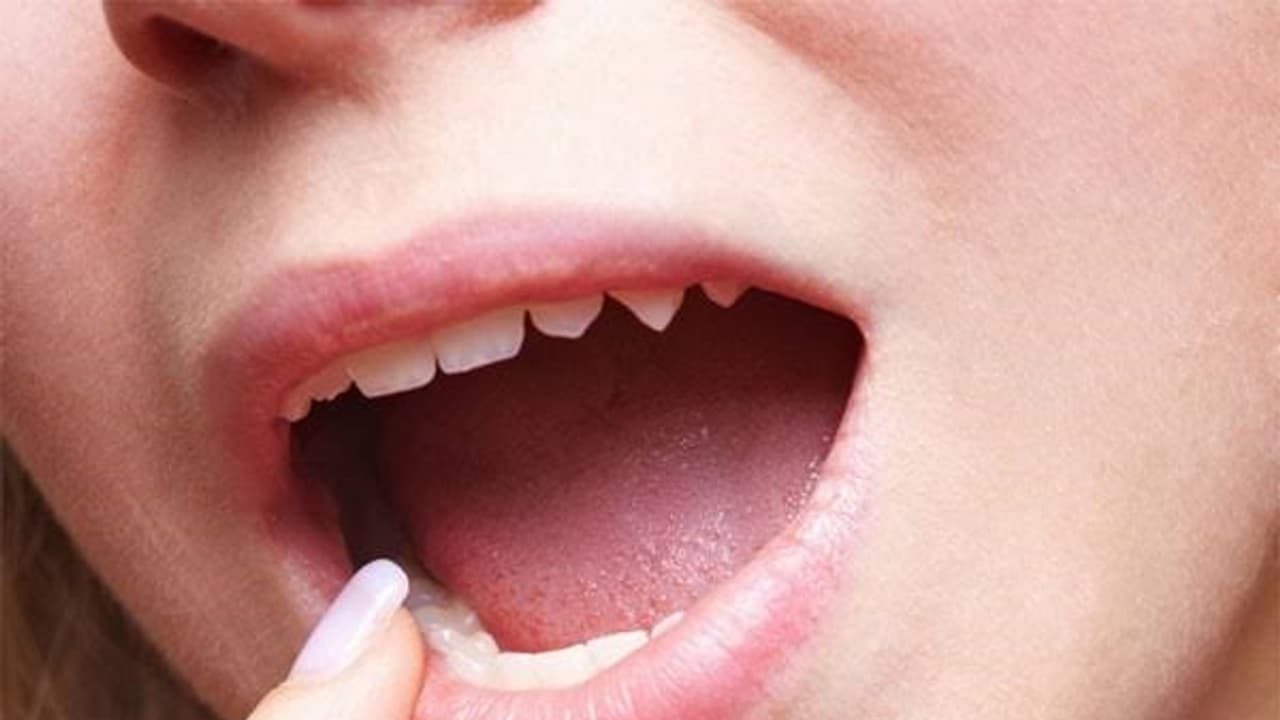 வாய்ப்புண் வந்தவுடன் அவஸ்தைபடுவதை விட வராமல் இருக்க இதெல்லாம் செய்யலாமே!...