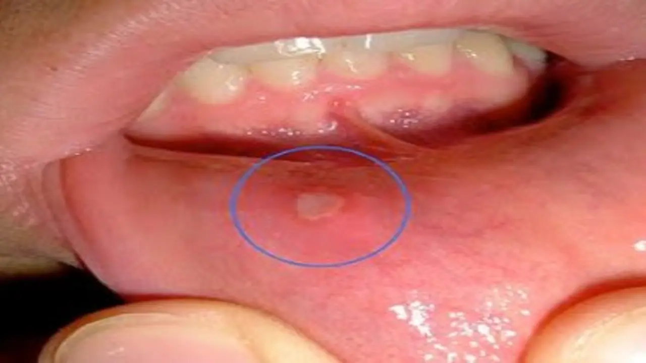 வாய்ப் புண்ணால் அவதியா? இதோவாய்ப்புண்ணை போக்க சில எளிய வழிகள்… வாய்ப் புண்ணால் அவதியா? இதோவாய்ப்புண்ணை போக்க சில எளிய வழிகள்…