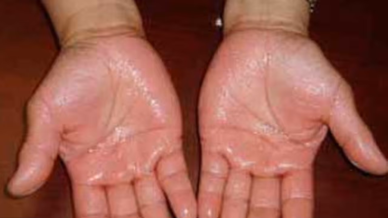 உங்கள் கை, கால்களில் அதிகமாக வியர்க்கிறதா? அதுகூட ஆபத்தான வியாதிதான்... இதை வாசிங்க தெரியும்... உங்கள் கை, கால்களில் அதிகமாக வியர்க்கிறதா? அதுகூட ஆபத்தான வியாதிதான்... இதை வாசிங்க தெரியும்...