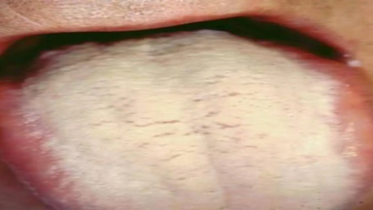 நாக்கின் மீது இருக்கும் வெள்ளைப் படலத்தை போக்க சில வழிகள்… நாக்கின் மீது இருக்கும் வெள்ளைப் படலத்தை போக்க சில வழிகள்…