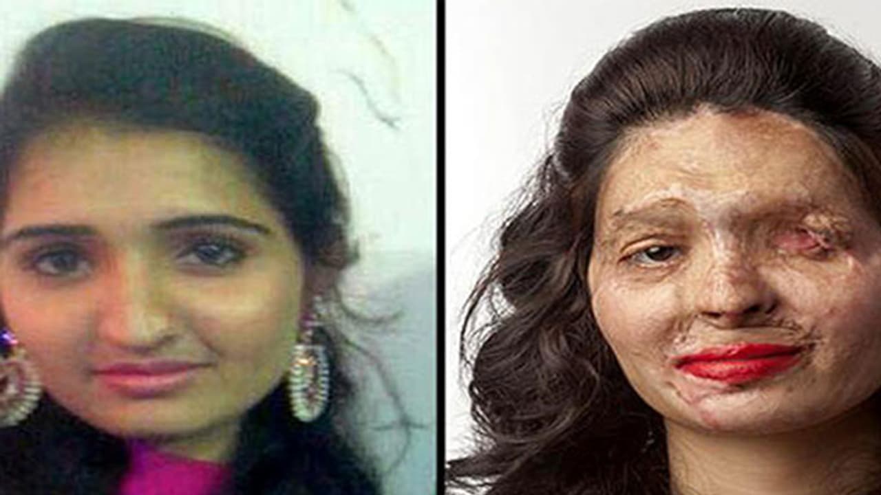 ಆ್ಯಸಿಡ್ ದಾಳಿಯಲ್ಲಿ ಸೌಂದರ್ಯ ಕಳೆದುಕೊಂಡಾಕೆ ಪ್ಯಾಶನ್ ಶೋನಲ್ಲಿ ಭಾಗವಹಿಸಿದಳು ಆ್ಯಸಿಡ್ ದಾಳಿಯಲ್ಲಿ ಸೌಂದರ್ಯ ಕಳೆದುಕೊಂಡಾಕೆ ಪ್ಯಾಶನ್ ಶೋನಲ್ಲಿ ಭಾಗವಹಿಸಿದಳು