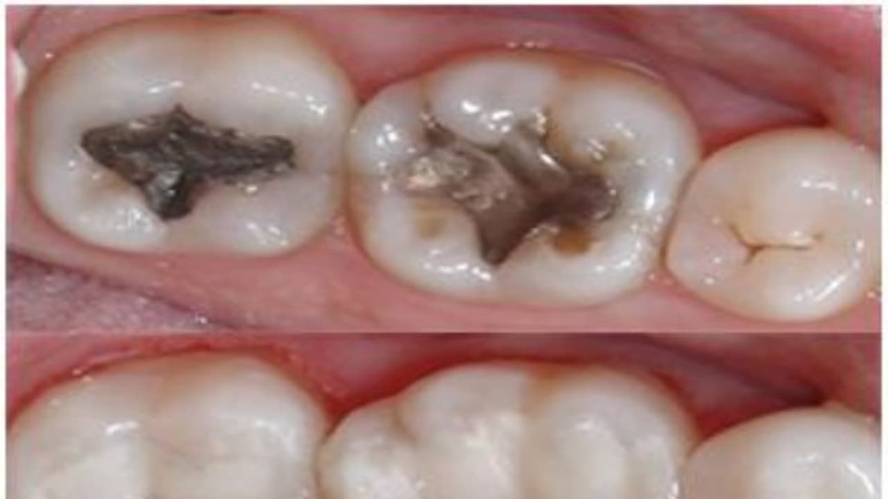 முட்டை ஓட்டைக் கொண்டு சொத்தைப் பற்களை போக்கலாம். எப்படி? முட்டை ஓட்டைக் கொண்டு சொத்தைப் பற்களை போக்கலாம். எப்படி?