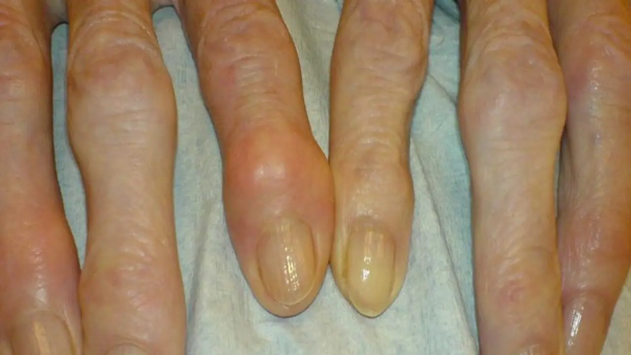 நகச்சுத்தி வந்தால் இனி கவலையே வேண்டாம்! இதோ டக்கரான எளிய மருத்துவ வழிகள்... நகச்சுத்தி வந்தால் இனி கவலையே வேண்டாம்! இதோ டக்கரான எளிய மருத்துவ வழிகள்...