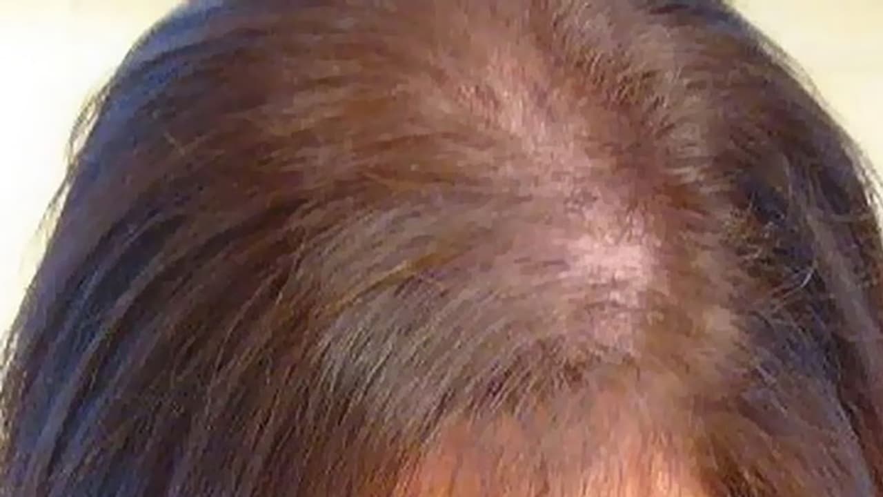 பெண்களுக்கும் வழுக்கை விழுது.. அது ஏன் தெரியுமா..? முக்கிய காரணம் இதுதான்..!