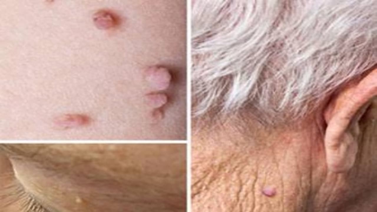 உடலில் எந்தப் பகுதியில் மரு இருந்தாலும் இந்த மருத்துவ முறையை பயன்படுத்தி போக்கலாம்... உடலில் எந்தப் பகுதியில் மரு இருந்தாலும் இந்த மருத்துவ முறையை பயன்படுத்தி போக்கலாம்...