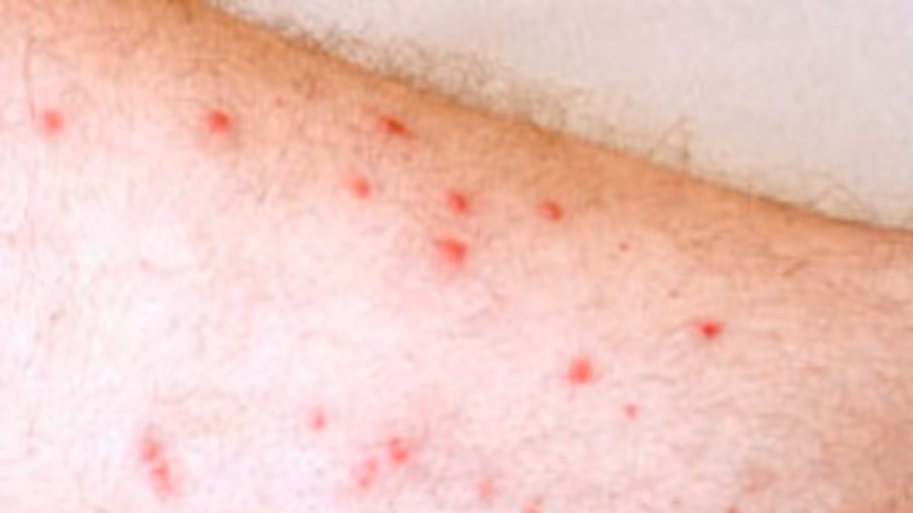 உடலில் சிவப்பு நிற புள்ளிகள் ஏற்பட இதுதான் காரணம்? தெரிஞ்சுக்குங்க உதவும்... உடலில் சிவப்பு நிற புள்ளிகள் ஏற்பட இதுதான் காரணம்? தெரிஞ்சுக்குங்க உதவும்...