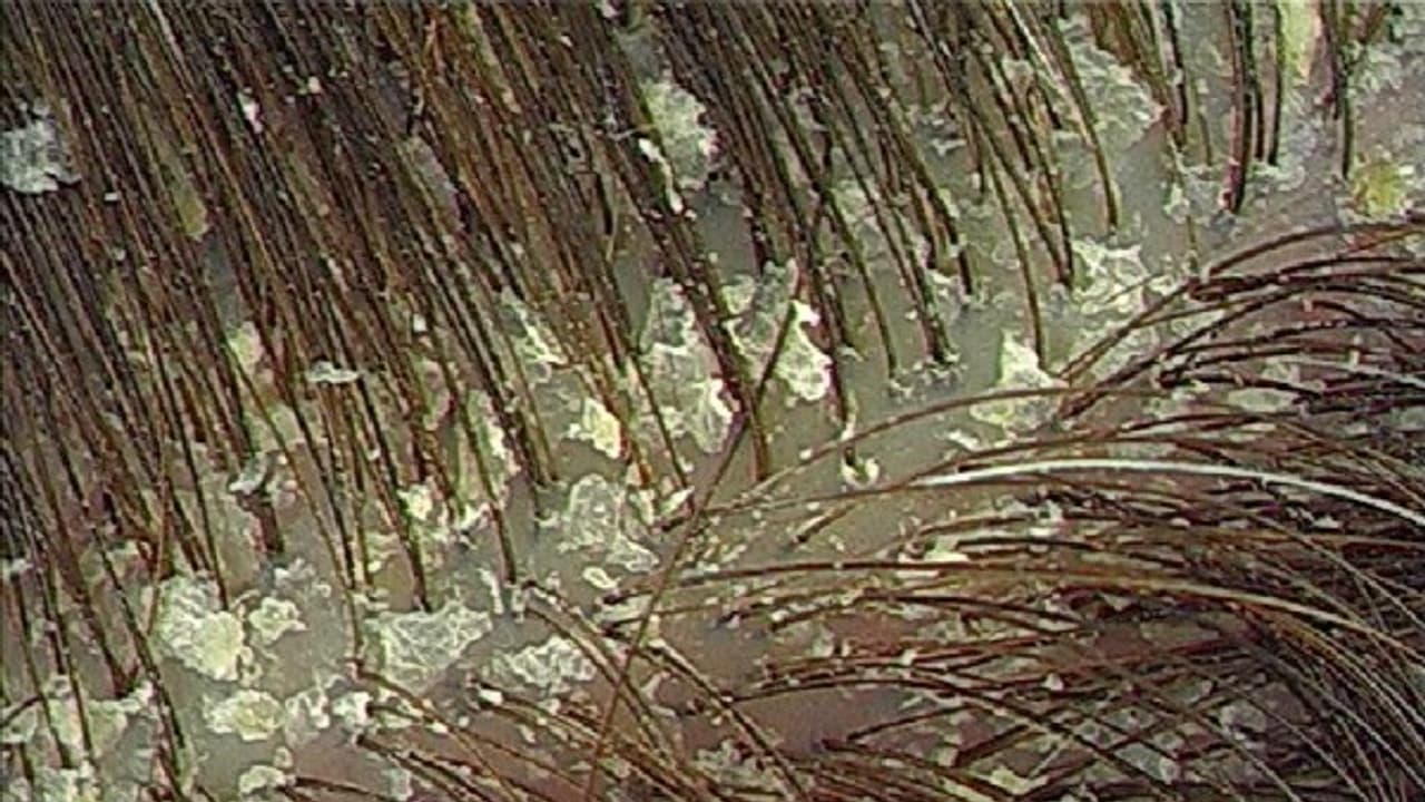 பொடுகு பிரச்சனையை அடியோடு விரட்டு 10 சூப்பரான டிப்ஸ்... ஏதாவது ஒன்றை செய்தாலே போதும்...