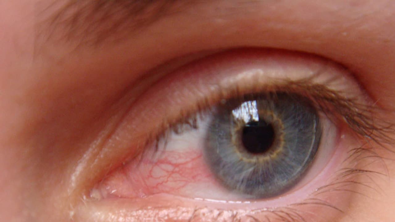 ചെങ്കണ്ണിനെ എങ്ങനെ പ്രതിരോധിക്കാം അറിയേണ്ട കാര്യങ്ങള്‍