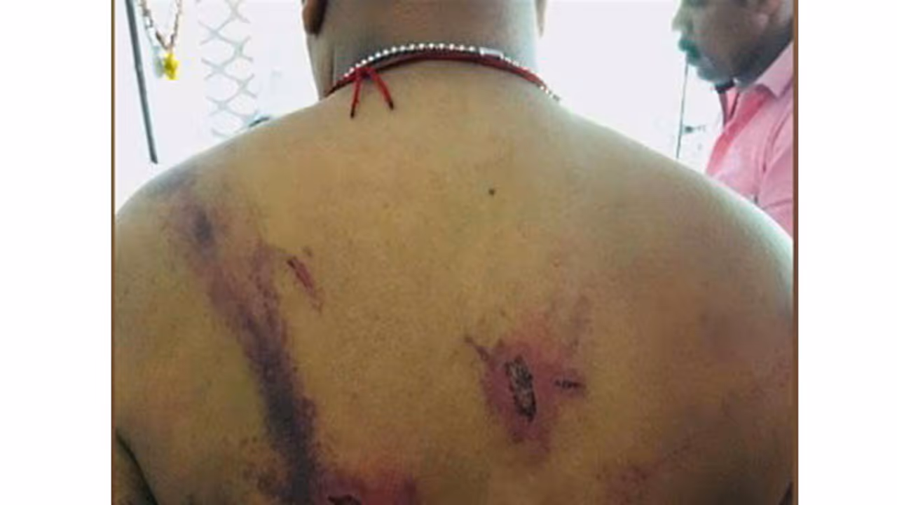 കസ്റ്റഡിയിലെടുത്ത ഡിവൈഎഫ്ഐ പ്രവര്‍ത്തകനെ പൊലീസ് ഹോക്കി സ്റ്റിക്ക് കൊണ്ട് മര്‍ദ്ദിച്ചെന്ന് പരാതി