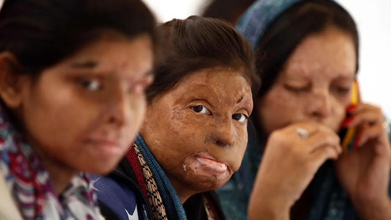 Ignored by state government, acid attack victims seek help in Chennai Ignored by state government, acid attack victims seek help in Chennai