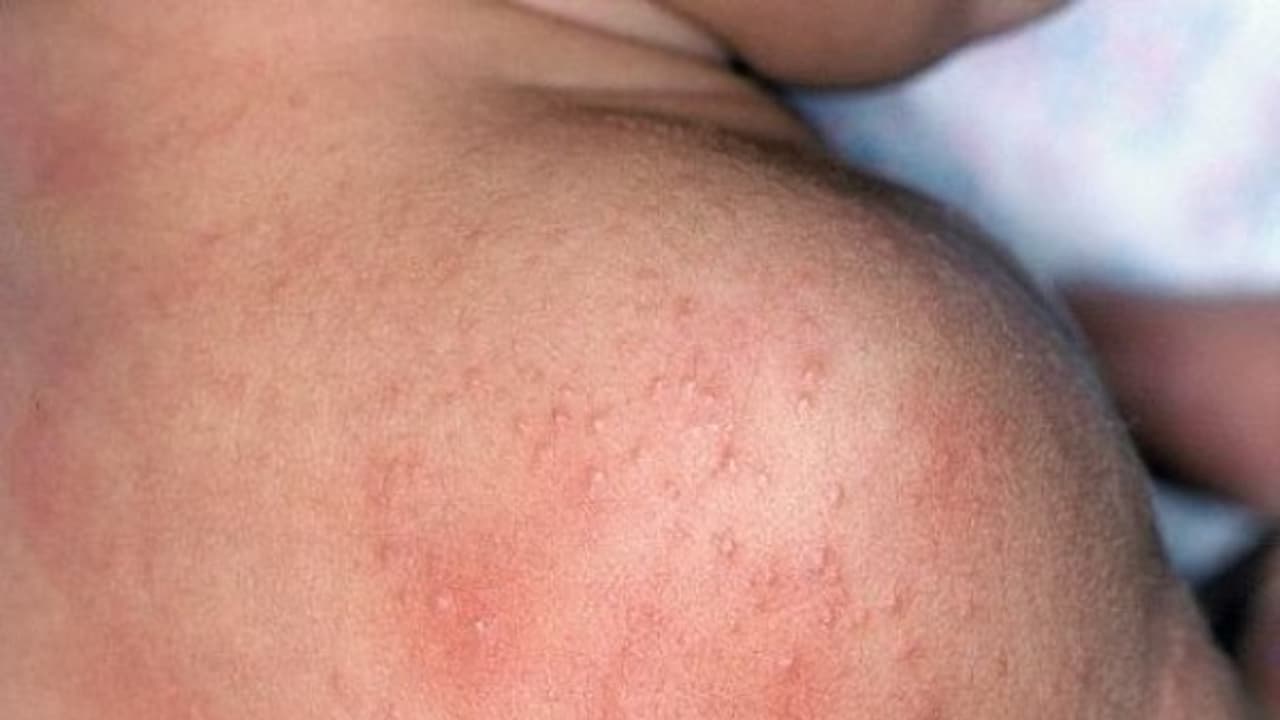 "வியர்குரு" கொடுமையா..? 2 மணி நேரத்தில் பறந்துபோக இதை செய்யுங்க..! "வியர்குரு" கொடுமையா..? 2 மணி நேரத்தில் பறந்துபோக இதை செய்யுங்க..!