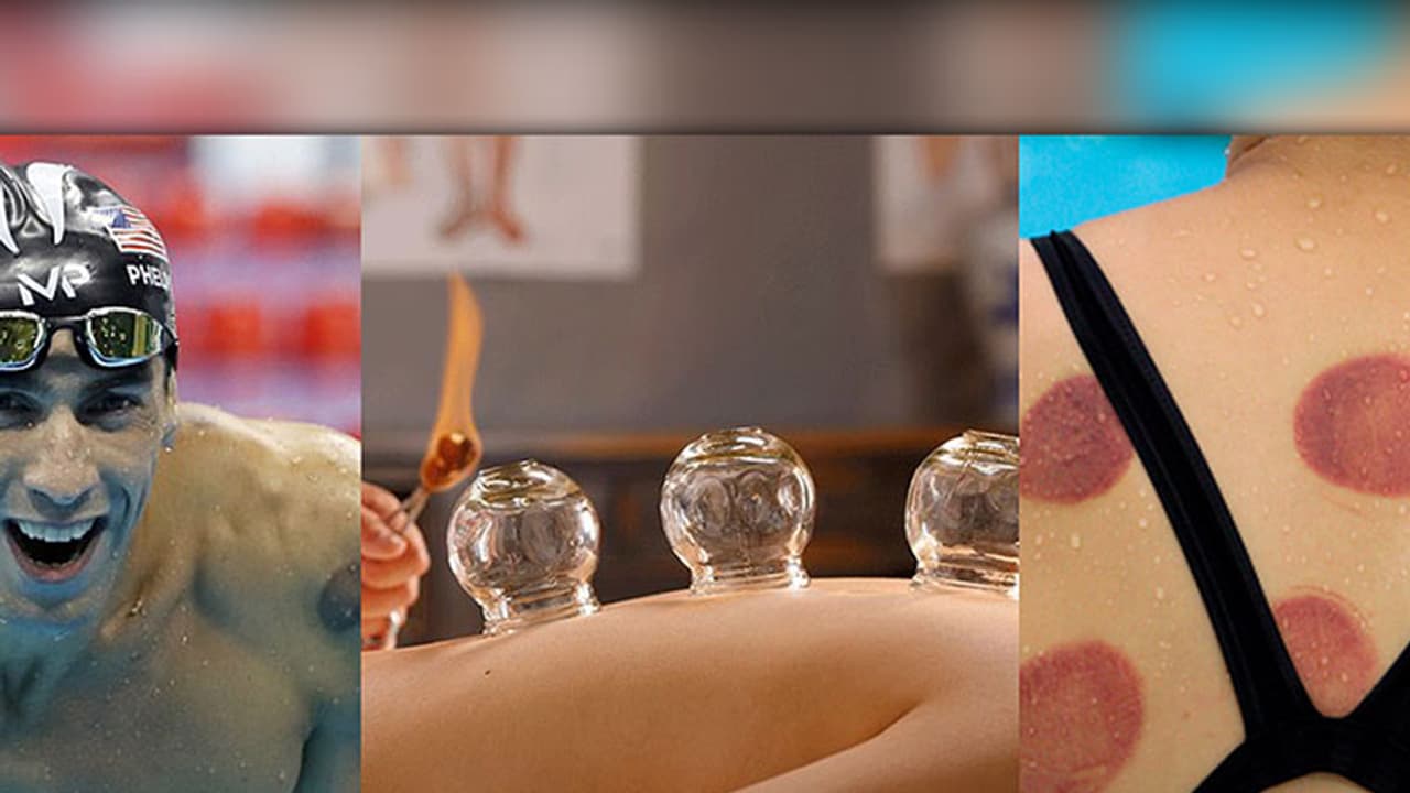 Ancient blood sucking therapy triggers angry debate on Facebook Ancient blood sucking therapy triggers angry debate on Facebook