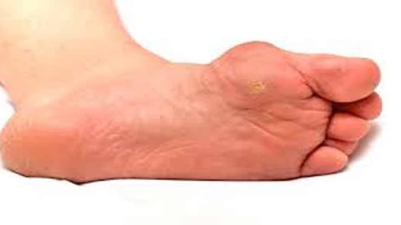  ‘கால் ஆணி’யை எப்படித் தவிர்ப்பது?