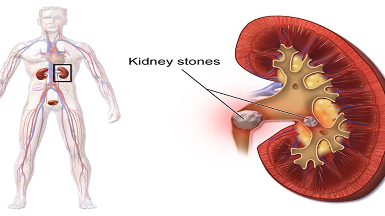 ಮೂತ್ರಪಿಂಡದ ಕಲ್ಲುಗಳ ನಿವಾರಣೆಗಾಗಿ ಮನೆಮದ್ದು ಮೂತ್ರಪಿಂಡದ ಕಲ್ಲುಗಳ ನಿವಾರಣೆಗಾಗಿ ಮನೆಮದ್ದು