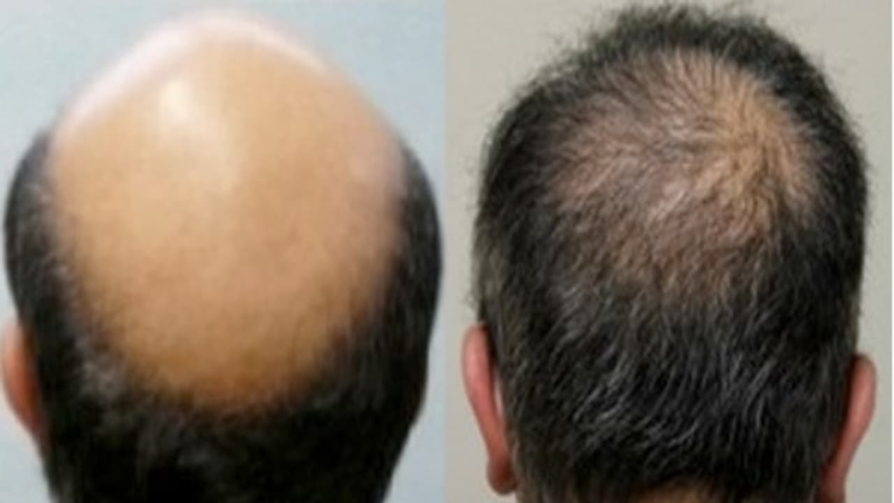 இந்த 4 டிப்ஸை பயன்படுத்தி வழுக்கை தலையிலும் முடி வளர செய்யலாம் : அட நம்புங்க...