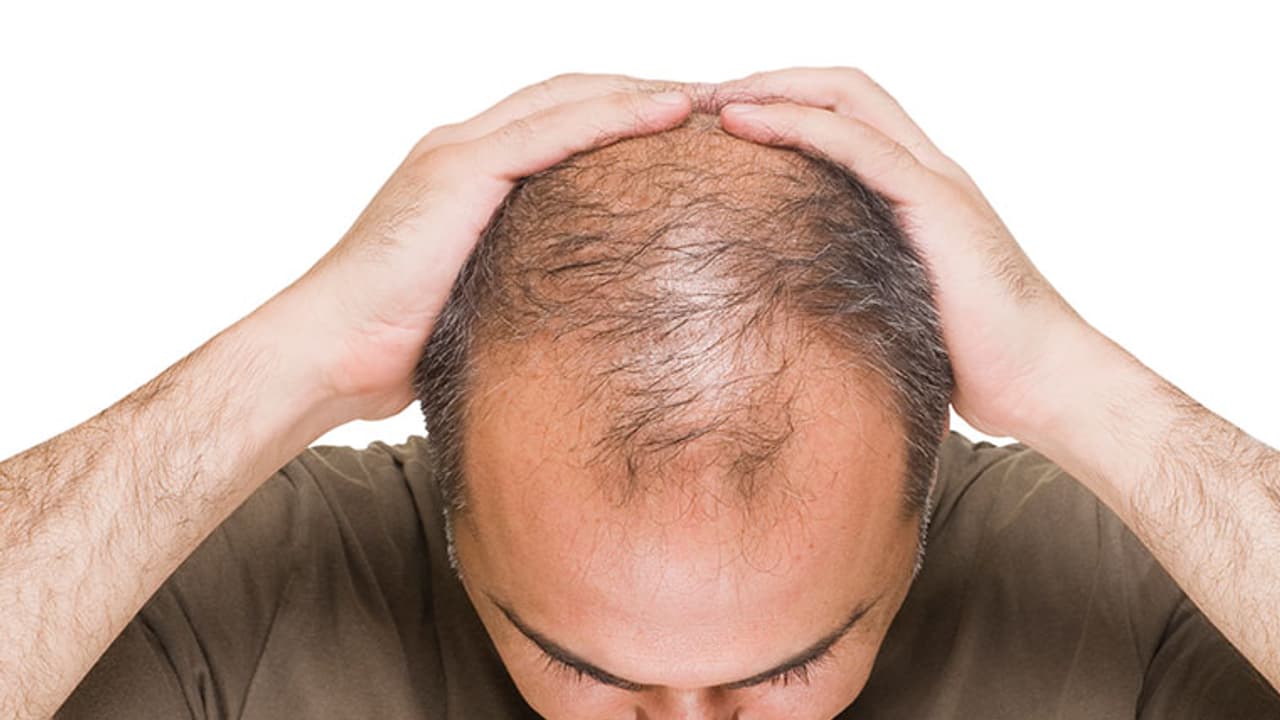 ಬೋಳು ತಲೆ ಅಥವಾ ಕೂದಲು ಉದುರುವ ಸಮಸ್ಯೆಯೇ? ಈ 7 ಆಹಾರ ಸೇವಿಸಿ ಬೋಳು ತಲೆ ಅಥವಾ ಕೂದಲು ಉದುರುವ ಸಮಸ್ಯೆಯೇ? ಈ 7 ಆಹಾರ ಸೇವಿಸಿ