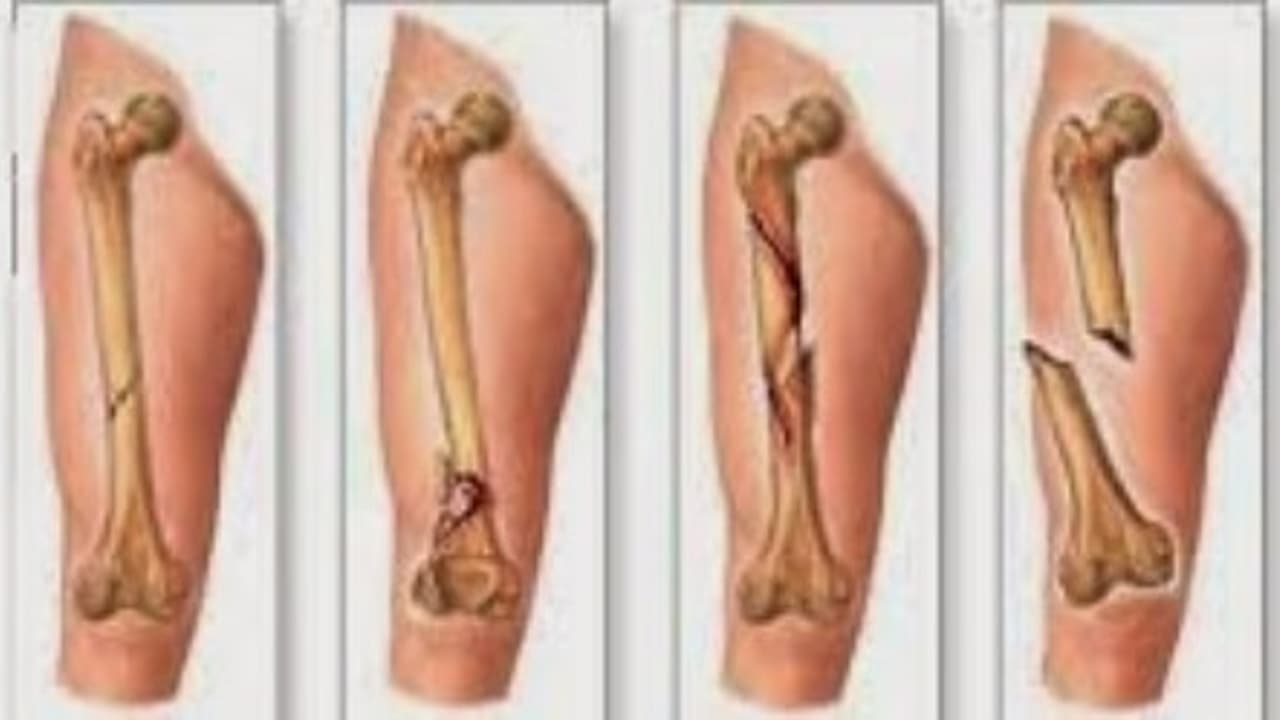 எலும்பு முறிவில் இருந்து தப்பிக்க இந்த உணவுகளை கட்டாயம் சாப்பிடுங்களேன்… எலும்பு முறிவில் இருந்து தப்பிக்க இந்த உணவுகளை கட்டாயம் சாப்பிடுங்களேன்…