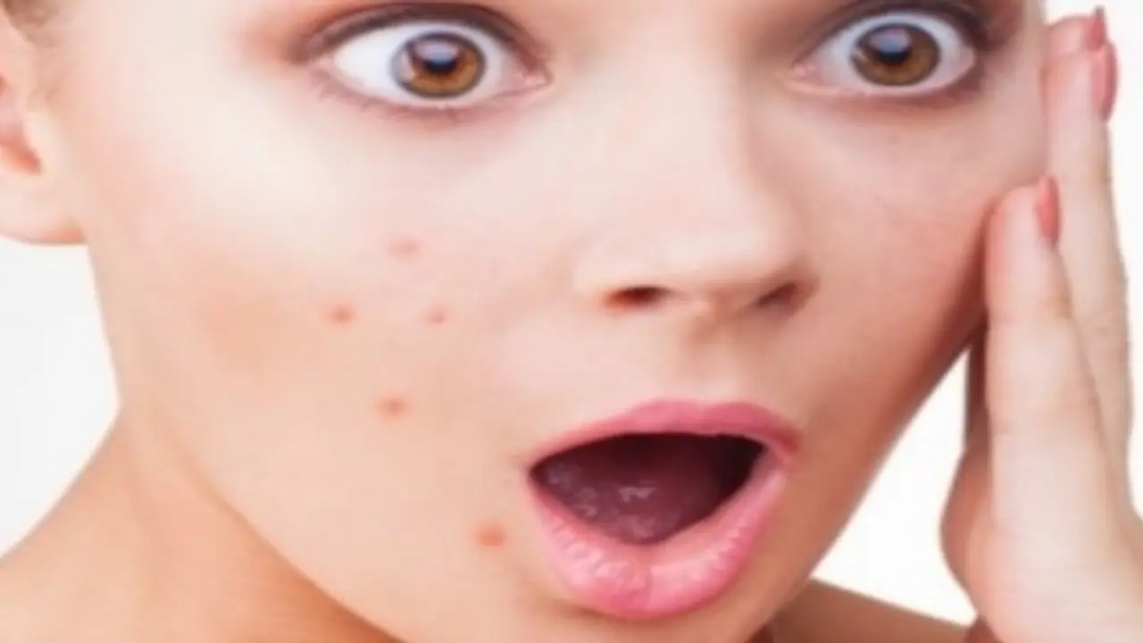 முகப்பரு ஏன் வருகிறது? அதனை போக்க சில வழிகள்… முகப்பரு ஏன் வருகிறது? அதனை போக்க சில வழிகள்…