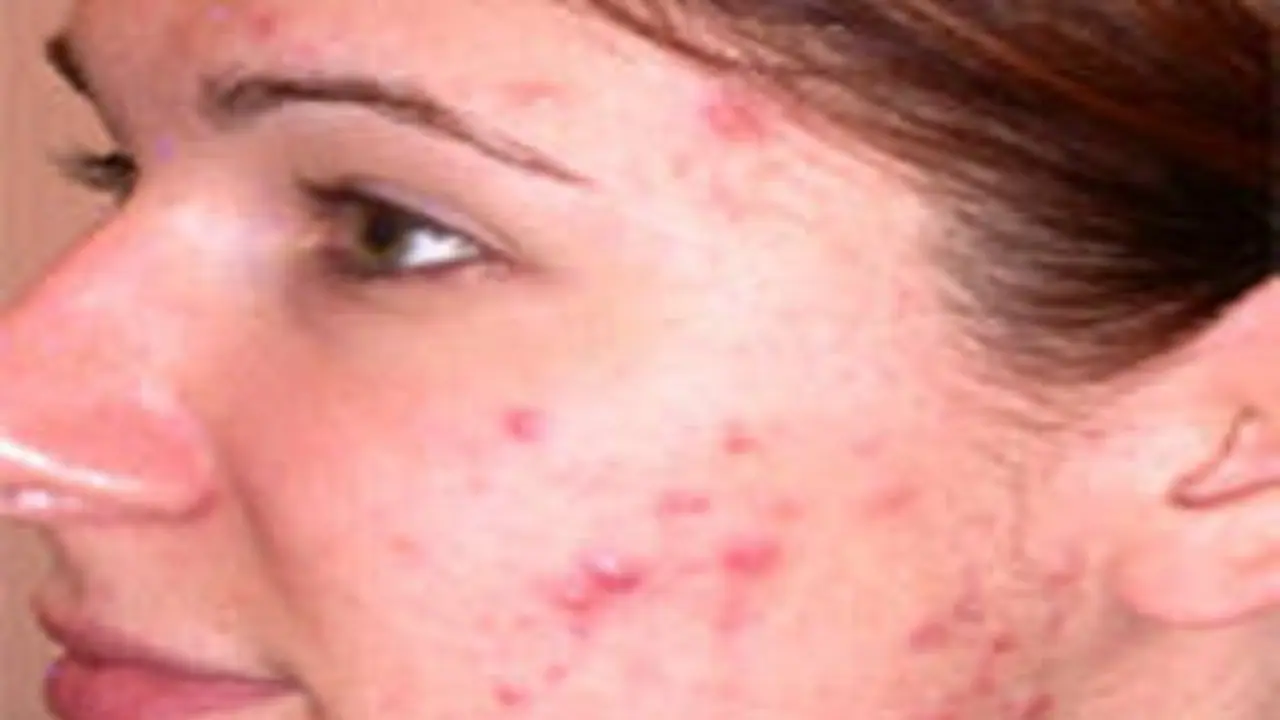 முகம் முழுவதும் பருக்கள் அதிகரிக்க இந்த ஐந்து பழக்கங்கள்தான் முக்கியமான காரணம்... முகம் முழுவதும் பருக்கள் அதிகரிக்க இந்த ஐந்து பழக்கங்கள்தான் முக்கியமான காரணம்...