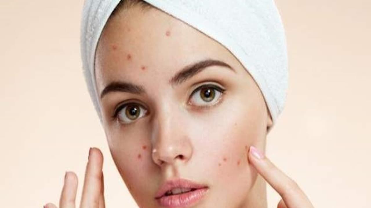 ஒரே நாளில் முகப்பருவை போக்க இதோ அட்டகாசமான டிப்ஸ்... ஆண்கள் கூட தாரளமாக முயற்சிக்கலாம்...