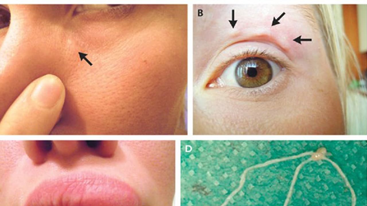മുഖത്തെ തൊലിക്കടിയില് ഓടിക്കളിക്കുന്ന വിരയുമായി യുവതി! മുഖത്തെ തൊലിക്കടിയില് ഓടിക്കളിക്കുന്ന വിരയുമായി യുവതി!