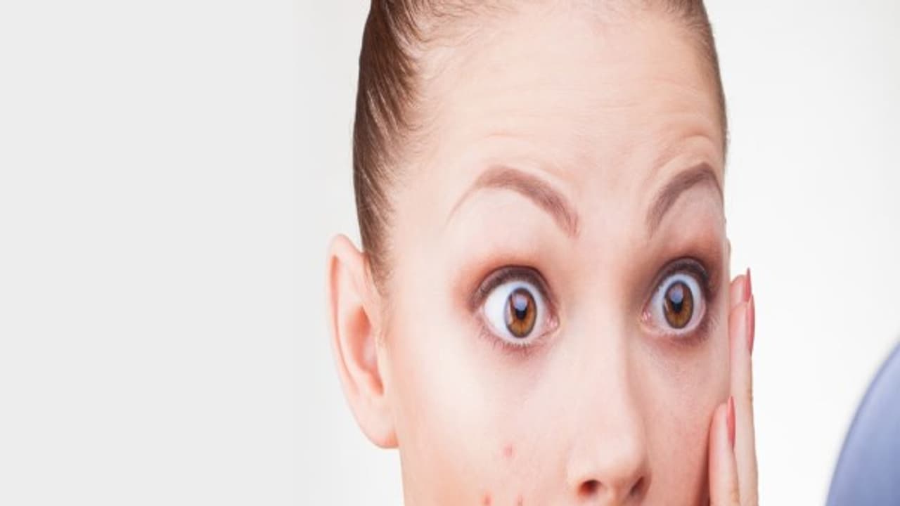 முகப்பருக்கள் இல்லாத வசீகரமான முகம் வேண்டுமா? இதோ அதற்கான ரகசியம்…!