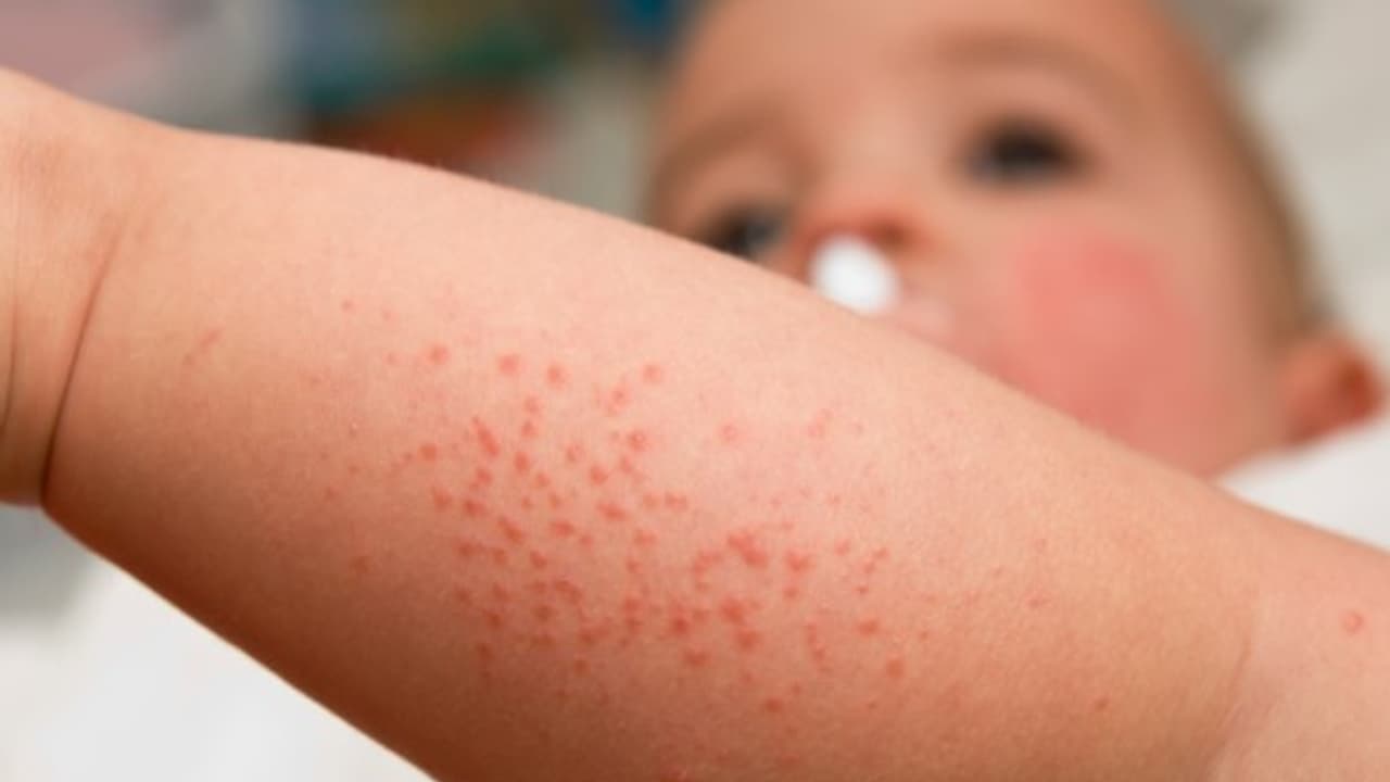 உங்களுக்குத் தெரியுமா? எக்ஸிமா நோயால் அமெரிக்காவில் 18 மில்லியன் மக்கள் பாதிக்கப்பட்டுள்ளனர்... உங்களுக்குத் தெரியுமா? எக்ஸிமா நோயால் அமெரிக்காவில் 18 மில்லியன் மக்கள் பாதிக்கப்பட்டுள்ளனர்...