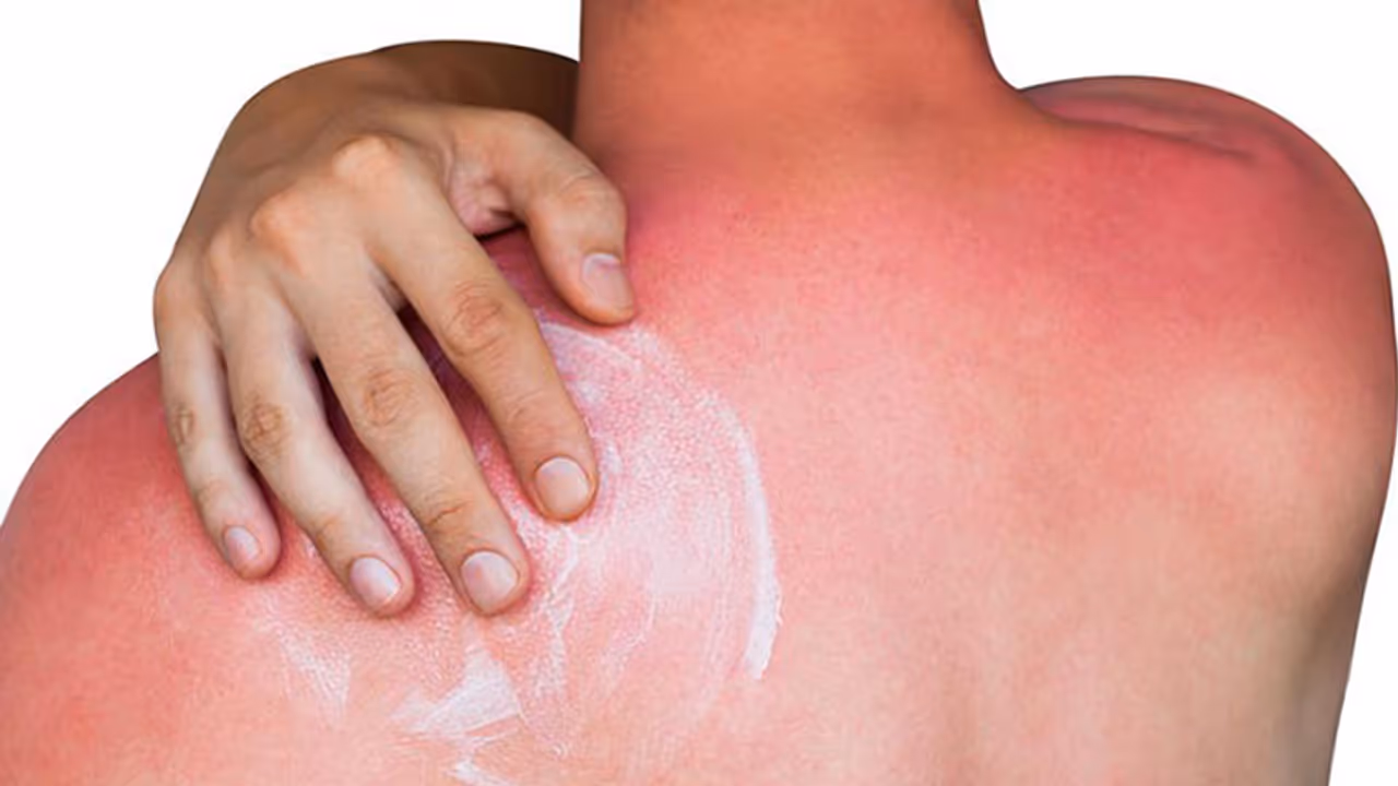 Health Tips: സംസ്ഥാനത്ത് ചൂട് കൂടുന്നു; സൂര്യാഘാത സാധ്യത തടയാന്‍ ചെയ്യേണ്ട കാര്യങ്ങള്‍