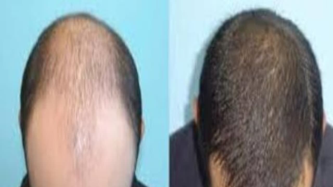 உங்களுக்குத் தெரியுமா? முடி உதிர்ந்த பின்னும் மீண்டும் வளர்ச்சியை அதிகரிக்க வெந்தயம் உதவும்... உங்களுக்குத் தெரியுமா? முடி உதிர்ந்த பின்னும் மீண்டும் வளர்ச்சியை அதிகரிக்க வெந்தயம் உதவும்...