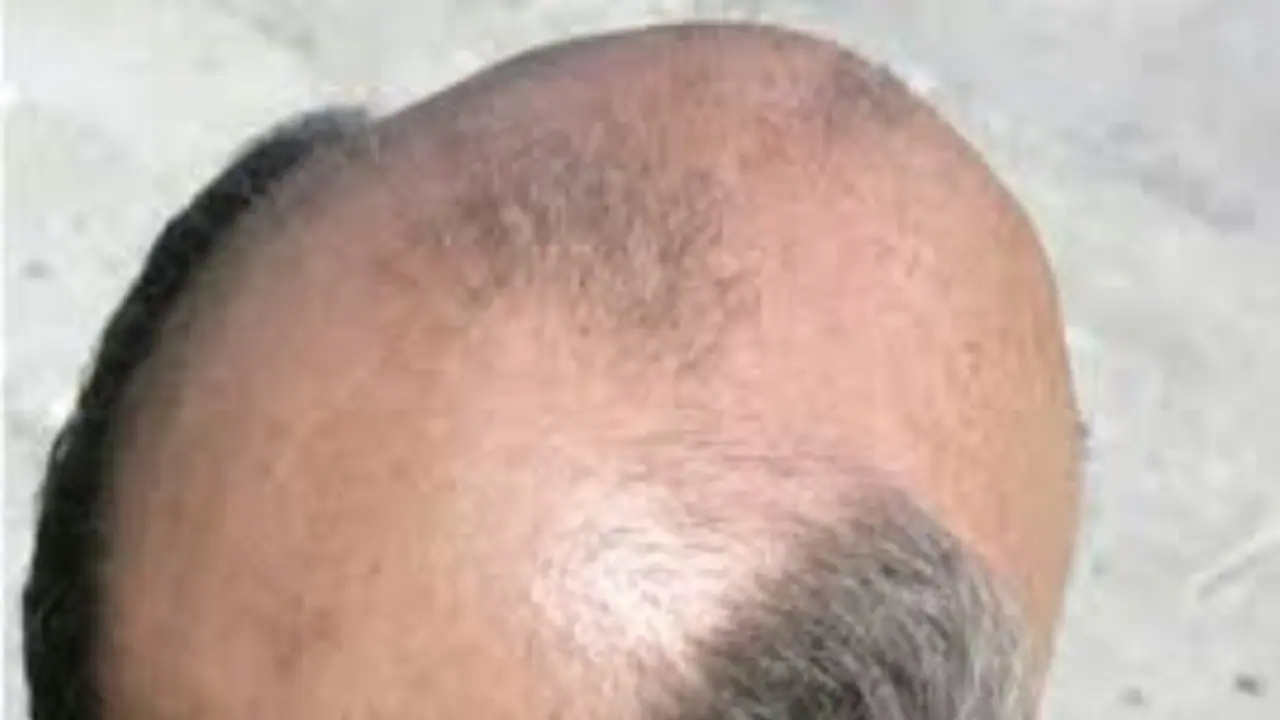 சொட்டை தலையில் கூட "முடி" வளர வேண்டுமா..? வெங்காயத்தை இப்படி தான் பயன்படுத்த வேண்டுமாம்... சொட்டை தலையில் கூட "முடி" வளர வேண்டுமா..? வெங்காயத்தை இப்படி தான் பயன்படுத்த வேண்டுமாம்...