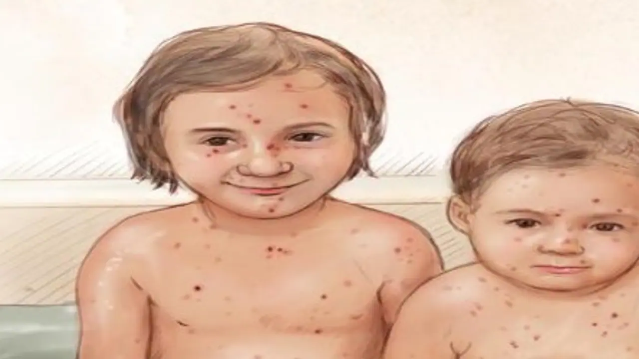 அம்மை நோயா? சாமியா? எது நிஜம் ? அம்மை நோயா? சாமியா? எது நிஜம் ?