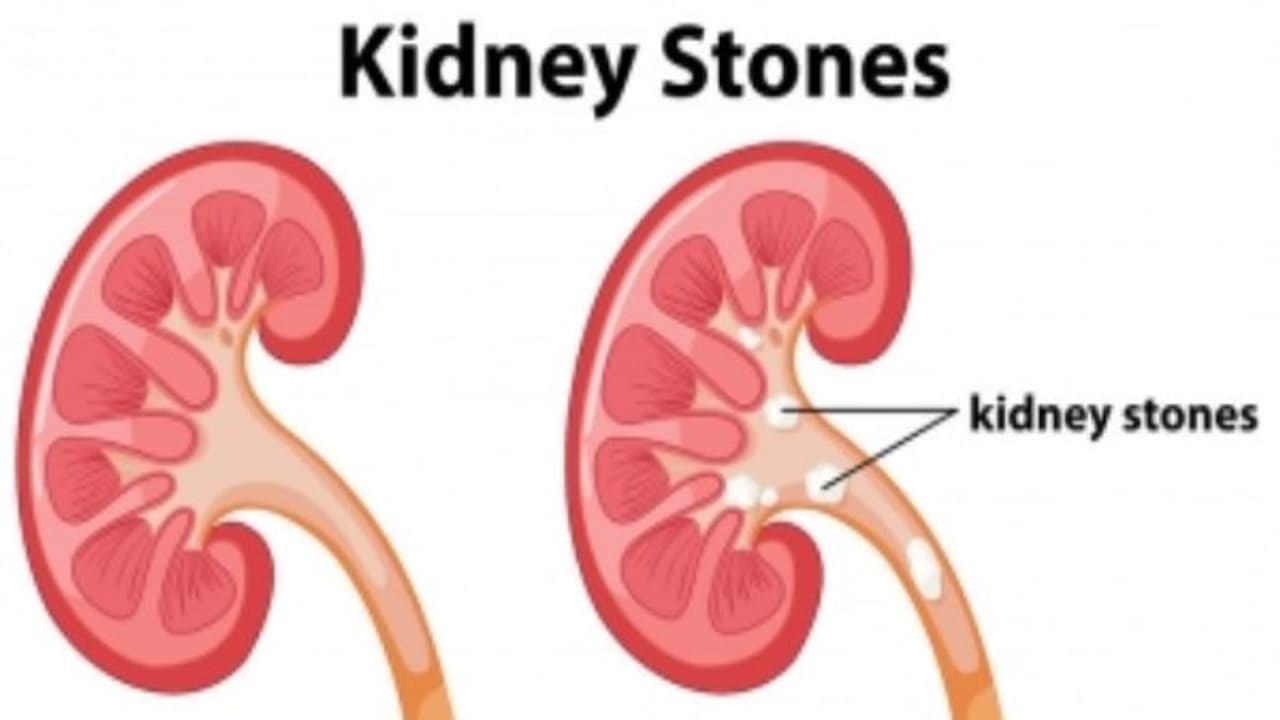 வீட்டு வைத்தியத்தின் மூலமே சிறுநீரக கல்லை குணமாக்கலாம்...எப்படி? வீட்டு வைத்தியத்தின் மூலமே சிறுநீரக கல்லை குணமாக்கலாம்...எப்படி?