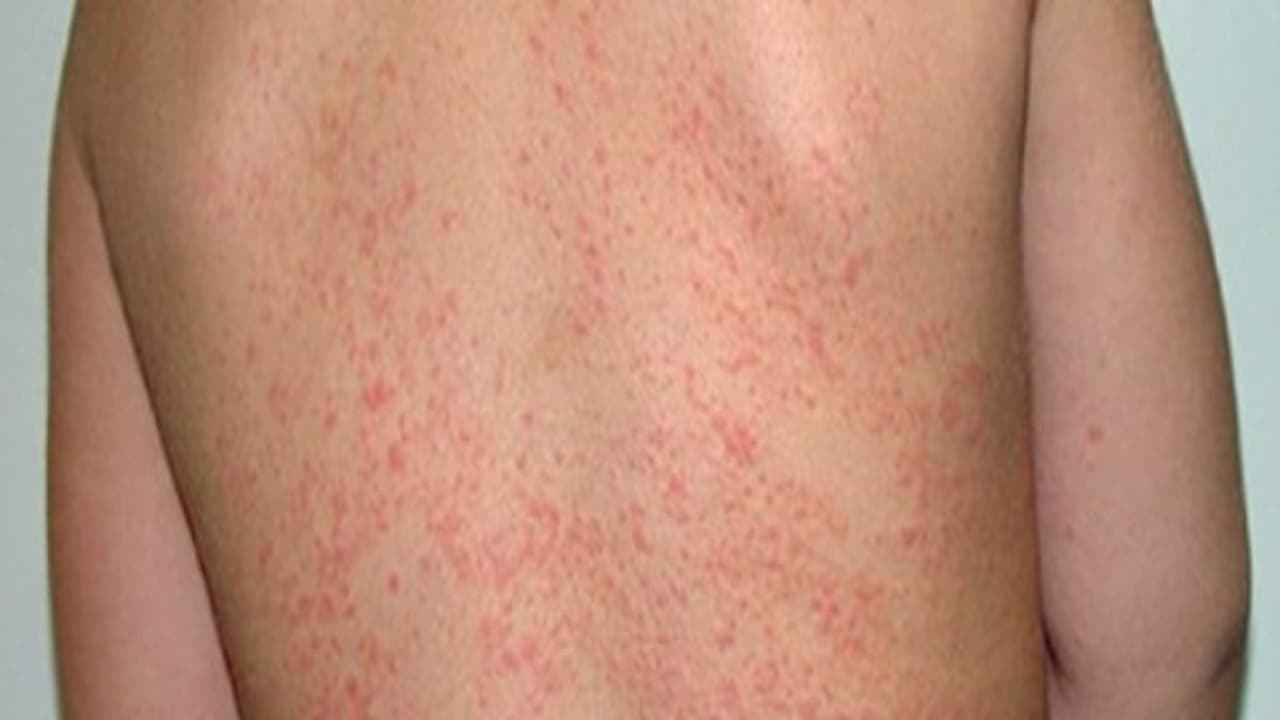 வெயில் காலத்தில் வரும் வியர்குருவால் ஒரே தொல்லையா இருக்கா? எரிச்சல் வேண்டாம்! இதோ சூப்பர் டிப்ஸ்... வெயில் காலத்தில் வரும் வியர்குருவால் ஒரே தொல்லையா இருக்கா? எரிச்சல் வேண்டாம்! இதோ சூப்பர் டிப்ஸ்...