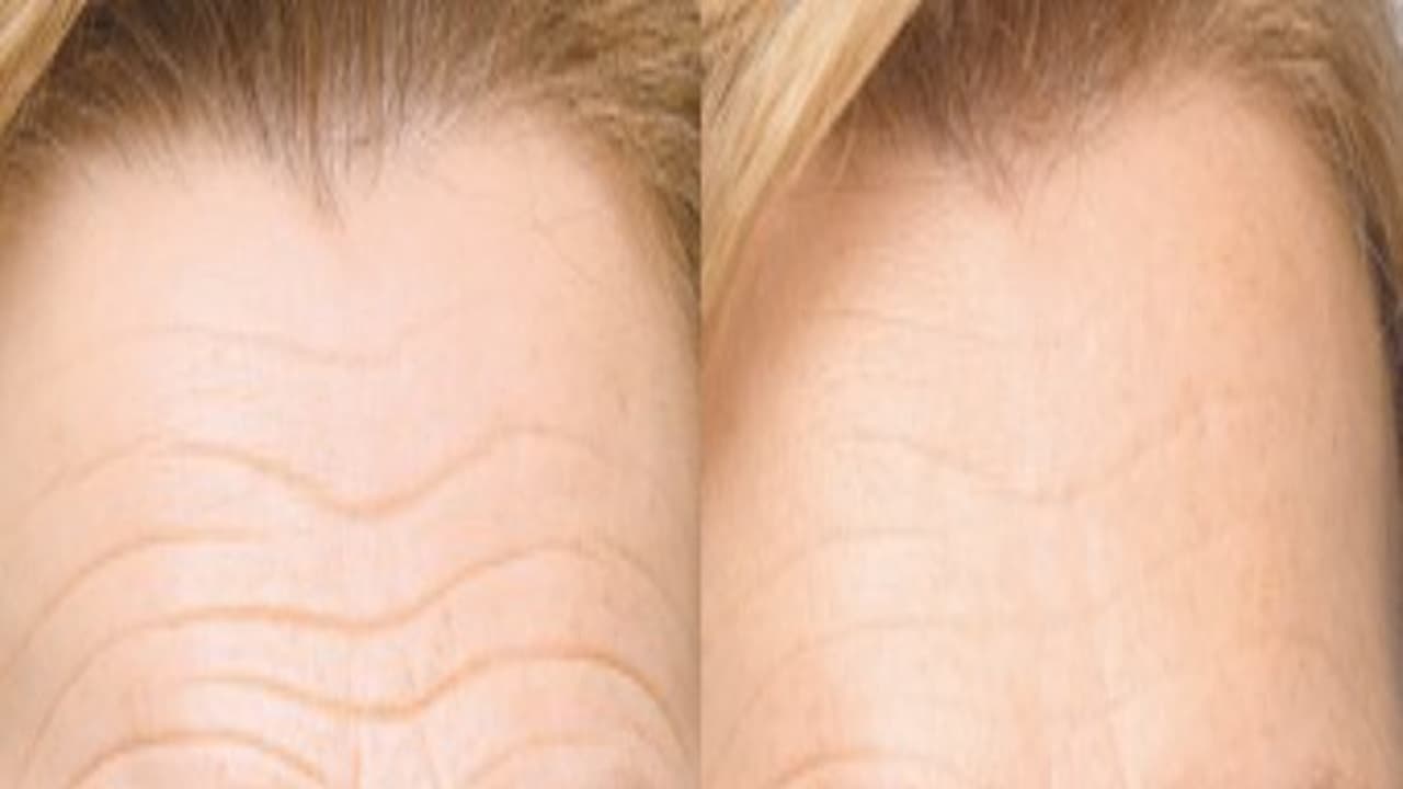 நெற்றியில் இருக்கும் சுருக்கத்தைப் போக்க இதோ அட்டகாசமான டிப்ஸ் ஆண், பெண் இருவரும் பயன்படுத்தலாம்... நெற்றியில் இருக்கும் சுருக்கத்தைப் போக்க இதோ அட்டகாசமான டிப்ஸ் ஆண், பெண் இருவரும் பயன்படுத்தலாம்...