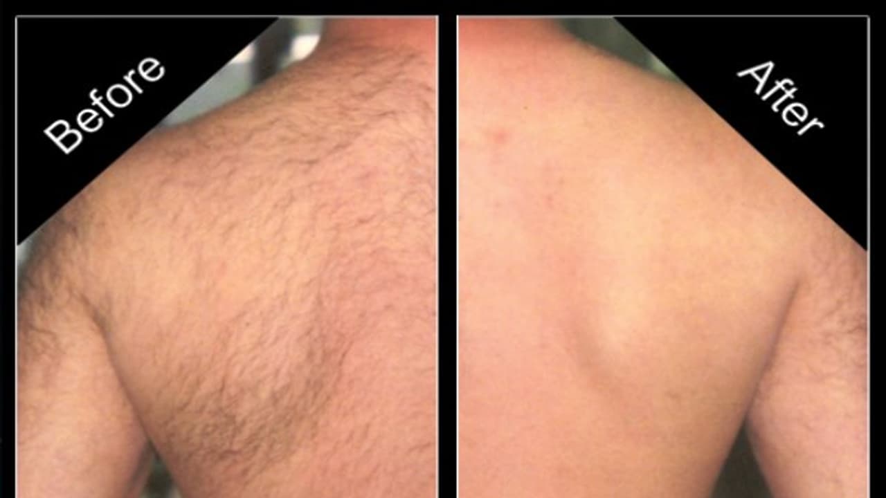 உடலில் உள்ள தேவையற்ற முடியை நீக்க...இதை தடவினாலே உதிர்ந்து விடும்..! உடலில் உள்ள தேவையற்ற முடியை நீக்க...இதை தடவினாலே உதிர்ந்து விடும்..!