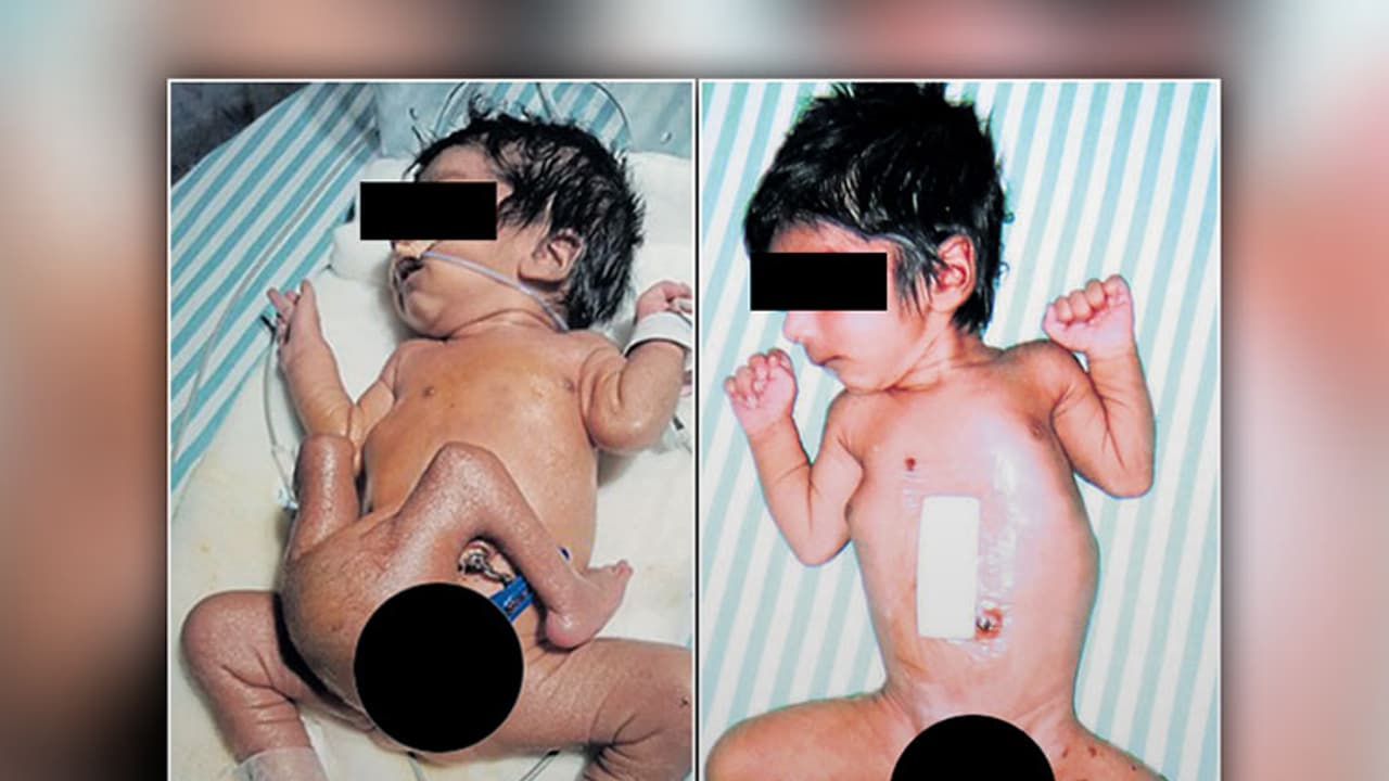 Normal again: Bengaluru hospital restores boy with four legs Normal again: Bengaluru hospital restores boy with four legs