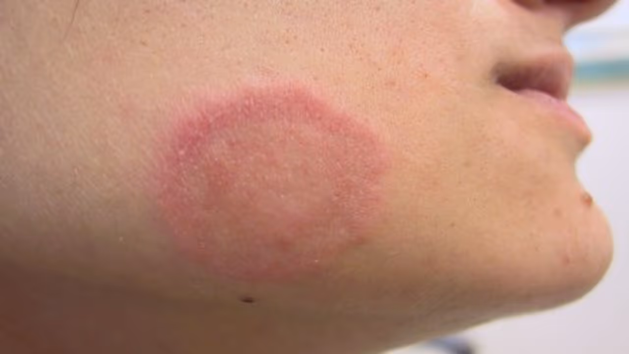 Ring worm: படர்தாமரையால் அவதிப்படுபவரா நீங்கள்? இந்த ஒரு பேஸ்ட் போதும் உடனடி நிவாரணம் கிடைக்கும்! Ring worm: படர்தாமரையால் அவதிப்படுபவரா நீங்கள்? இந்த ஒரு பேஸ்ட் போதும் உடனடி நிவாரணம் கிடைக்கும்!