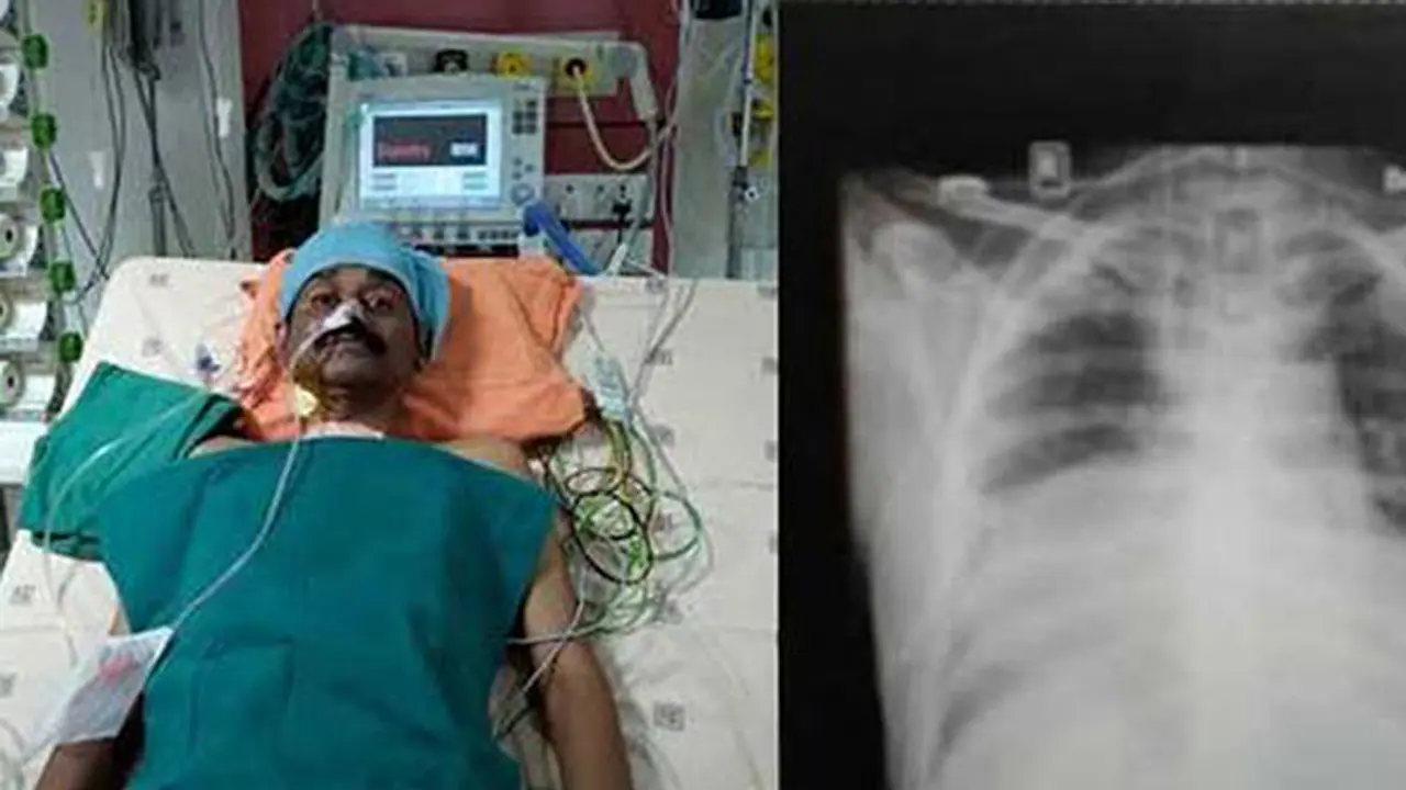 Kerala man lives with two beating hearts after rare transplant