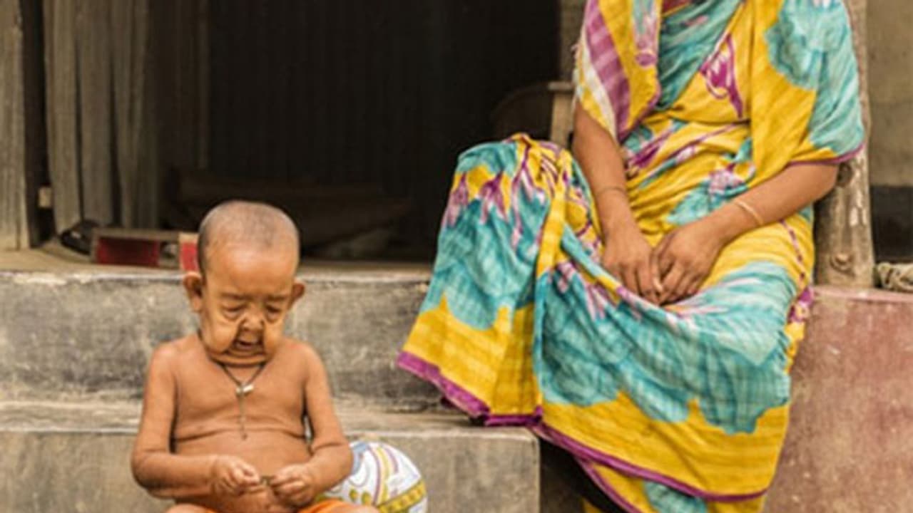 നാല് വയസ് പക്ഷെ എഴുപത് വയസിന്‍റെ ശരീരവുമായി ഒരു കുട്ടി