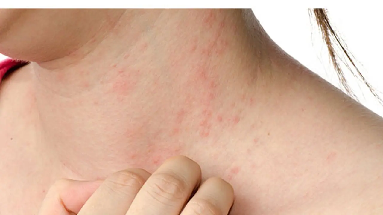 Managing Psoriasis: ಸೋರಿಯಾಸಿಸ್ ನಿಭಾಯಿಸುವುದು ಹೇಗೆ? Managing Psoriasis: ಸೋರಿಯಾಸಿಸ್ ನಿಭಾಯಿಸುವುದು ಹೇಗೆ?