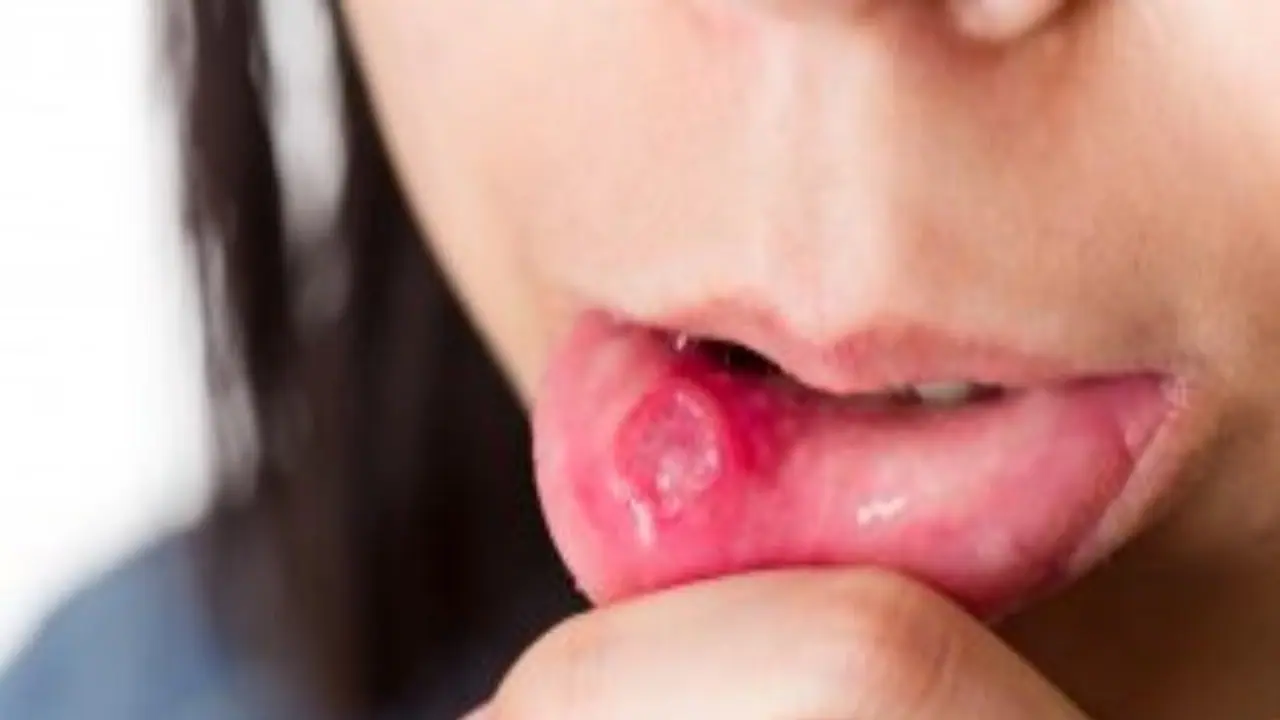 வாய்ப்புண் ஏற்பட என்னவெல்லாம் காரணங்கள் இருக்கு? இதை படிச்சு உஷாரா இருங்க... வாய்ப்புண் ஏற்பட என்னவெல்லாம் காரணங்கள் இருக்கு? இதை படிச்சு உஷாரா இருங்க...