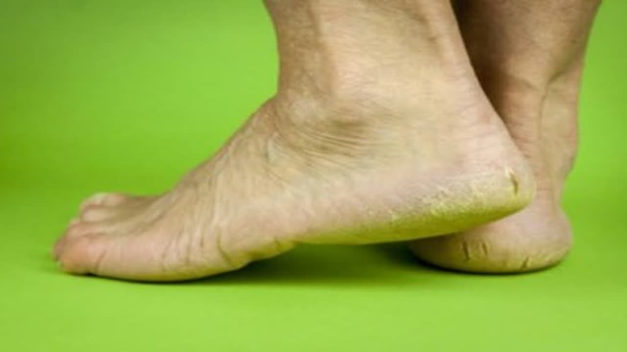 உங்களுக்குத் தெரியுமா? பாதவெடிப்புக்கு இஞ்சி, மஞ்சள், குப்பைமேனி போன்றவை தீர்வளிக்கும்…